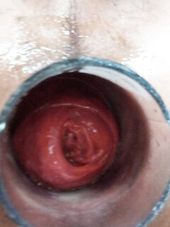 anal soi 2